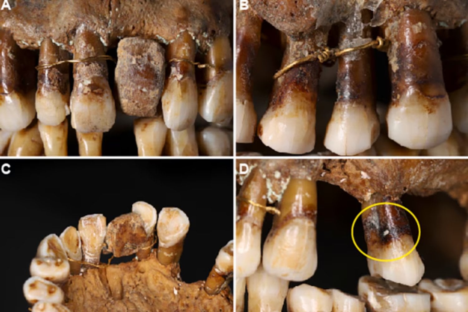 Una condesa del siglo XVII se ató los dientes con hilo de oro para no perderlos. Cuatro siglos después, los escáneres revelaron que el costoso remedio probablemente empeoró su boca