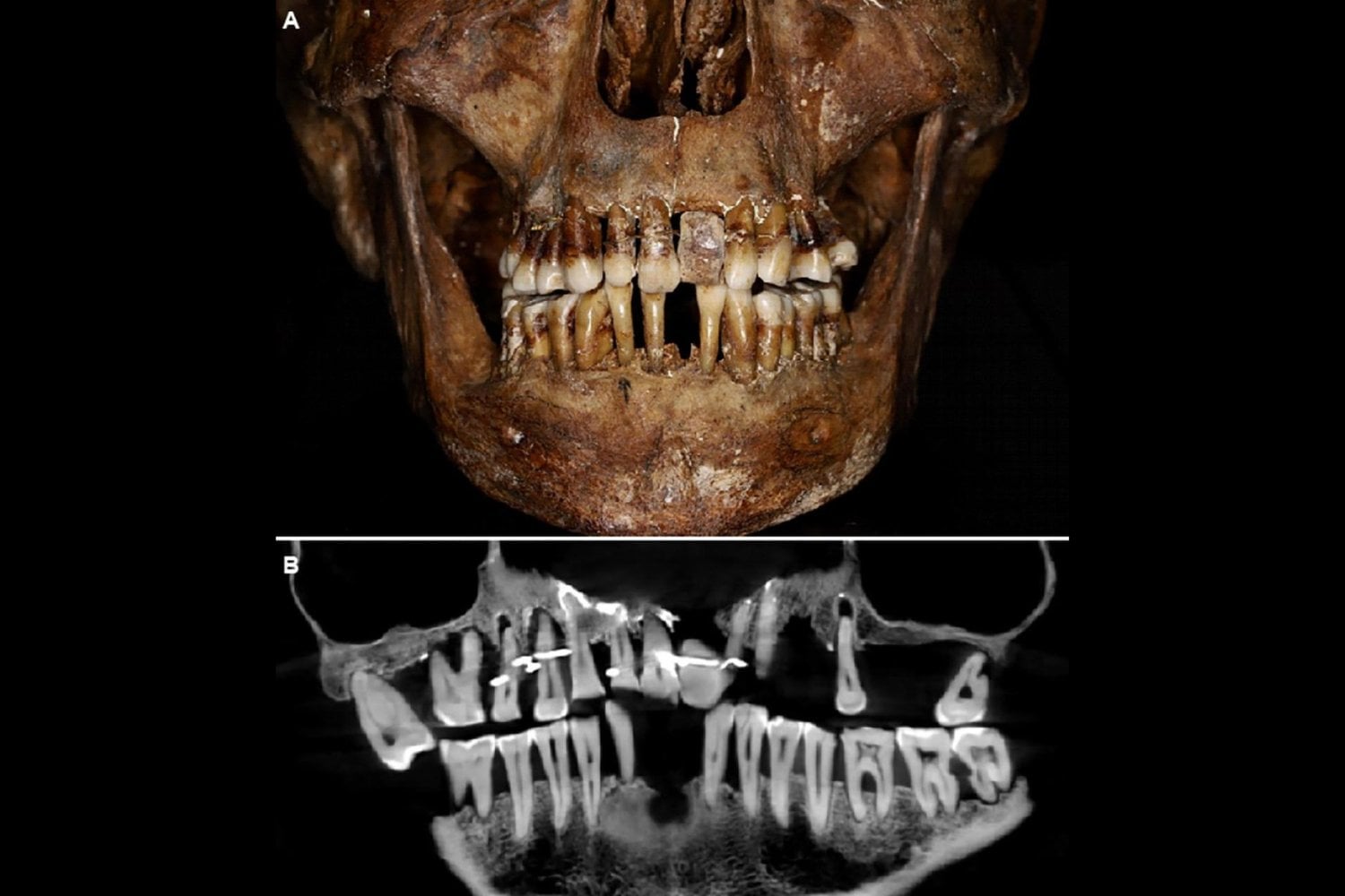 Una condesa del siglo XVII se ató los dientes con hilo de oro para no perderlos. Cuatro siglos después, los escáneres revelaron que el costoso remedio probablemente empeoró su boca