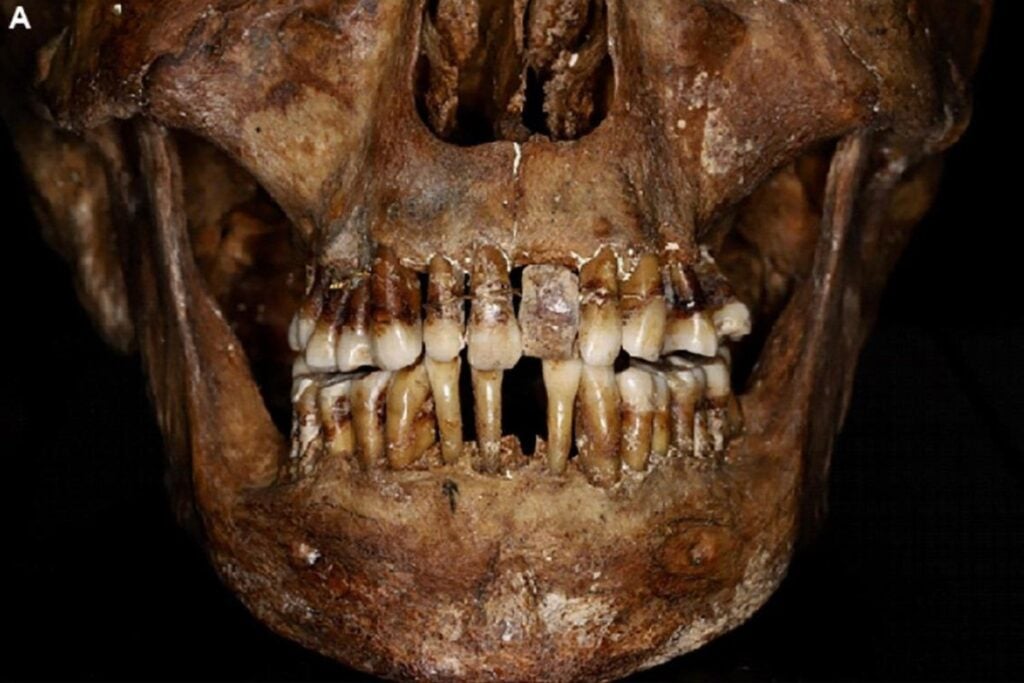 Una condesa del siglo XVII se ató los dientes con hilo de oro para no perderlos. Cuatro siglos después, los escáneres revelaron que el costoso remedio probablemente empeoró su boca