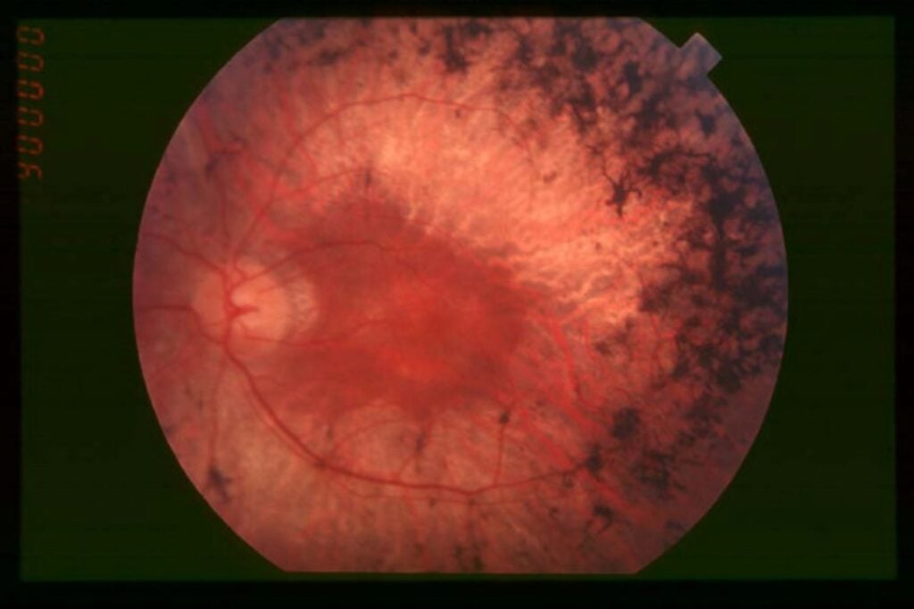 La retina había dejado de responder a la luz. Entonces los investigadores probaron una inyección de nanopartículas y el resultado fue fascinante