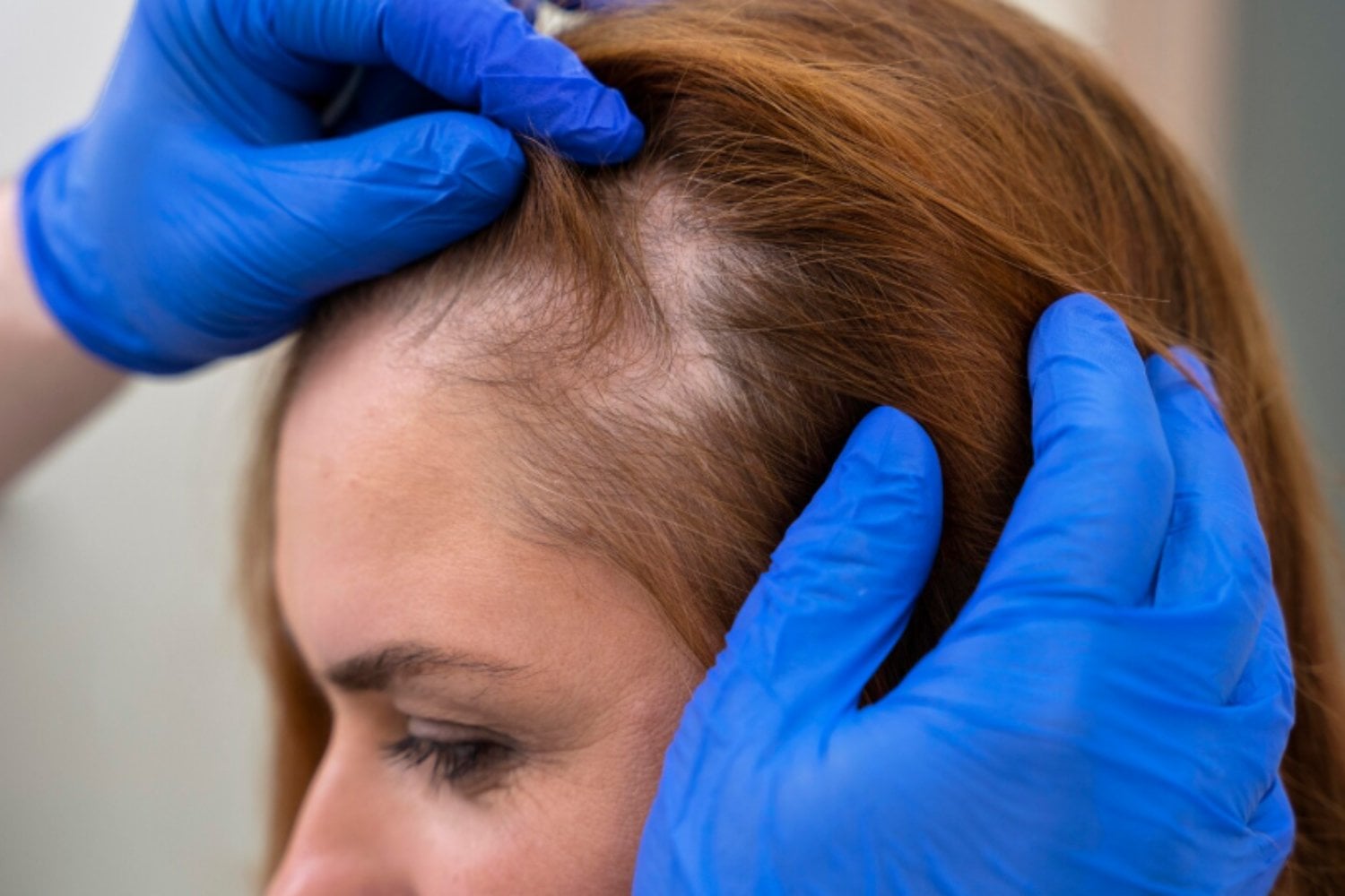 La caída del pelo después del verano es habitual, pero hay un momento en el que conviene consultar