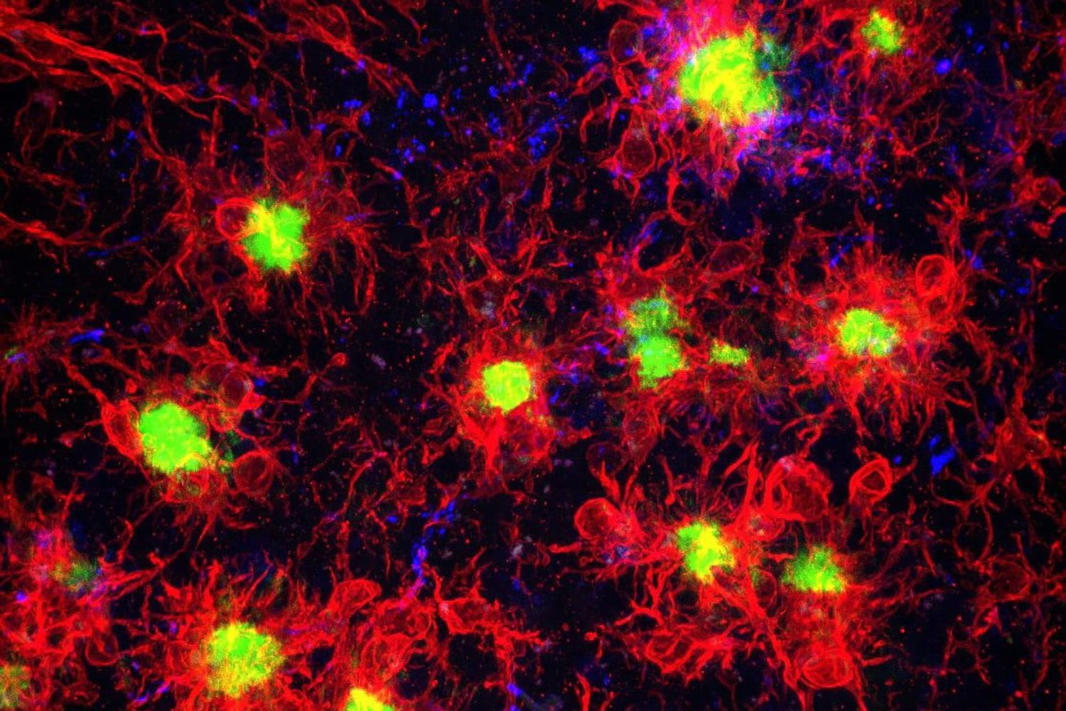 Un análisis de sangre podría anticipar el riesgo de Alzheimer hasta diez años antes de los síntomas. Los científicos encontraron una proteína que revela quiénes tienen más probabilidades de sufrir deterioro cognitivo
