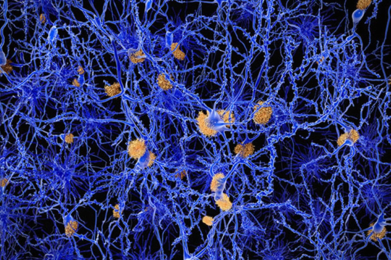 Un análisis de sangre podría anticipar el riesgo de Alzheimer hasta diez años antes de los síntomas. Los científicos encontraron una proteína que revela quiénes tienen más probabilidades de sufrir deterioro cognitivo