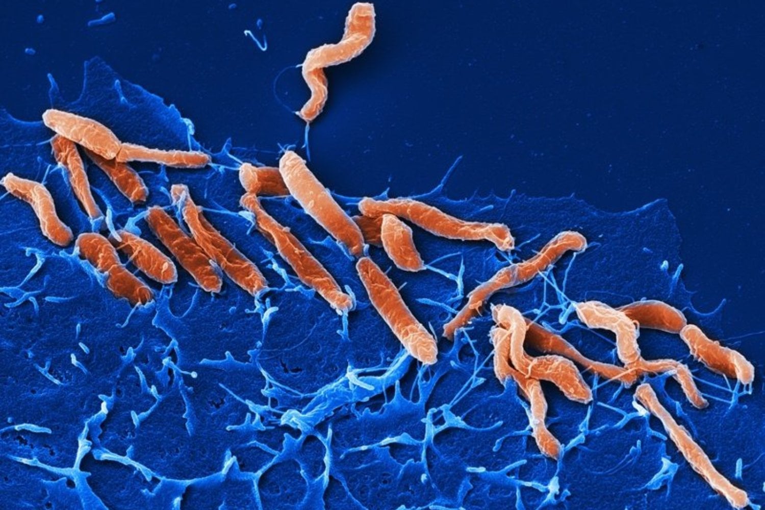 Millones de personas desarrollan cáncer por infecciones que podrían prevenirse. Un nuevo estudio revela que una de cada ocho diagnósticos tiene ese origen