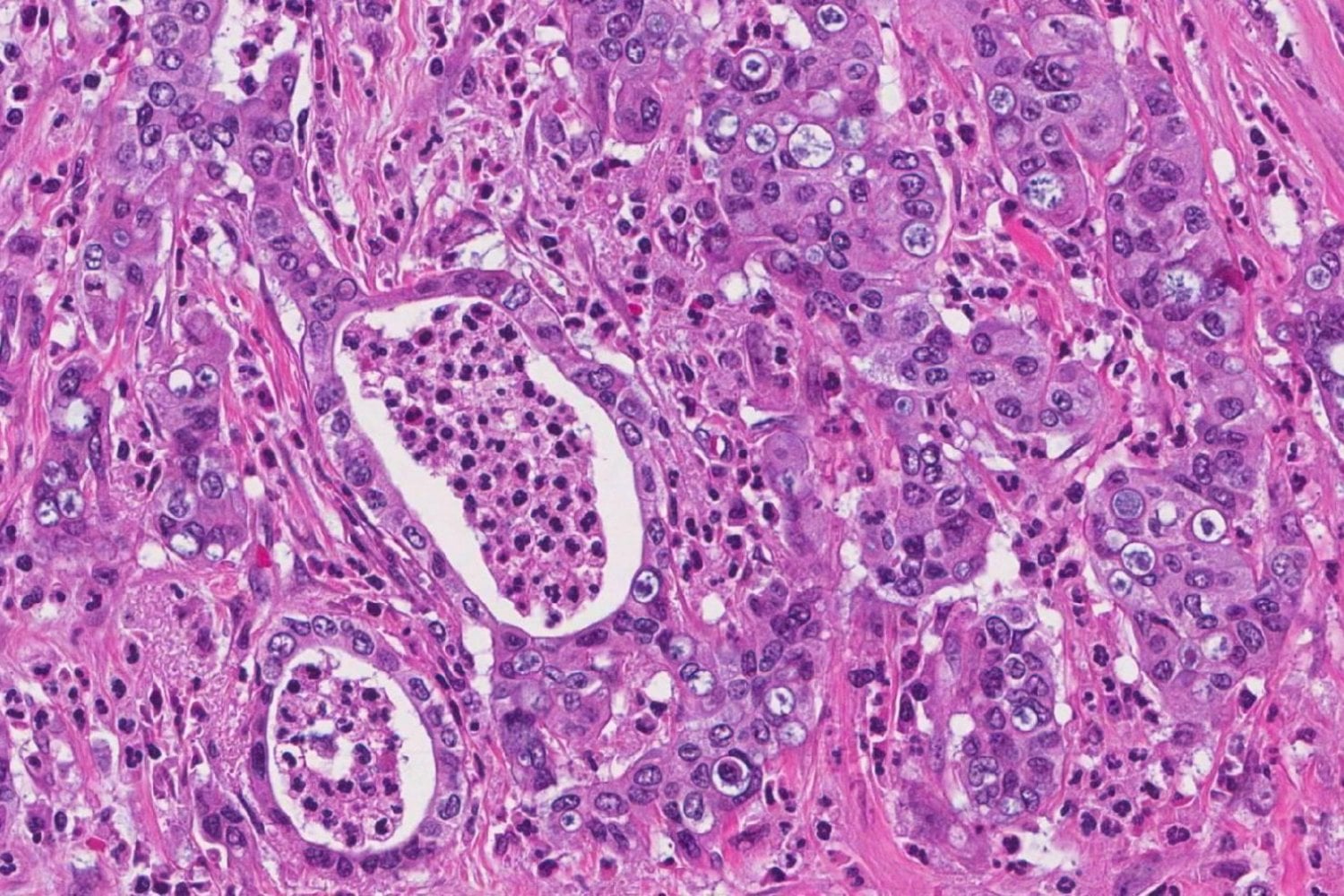 Después de 40 años intentando bloquear una de las claves del cáncer, una pastilla consigue lo que parecía imposible. Europa está a un paso de autorizarla