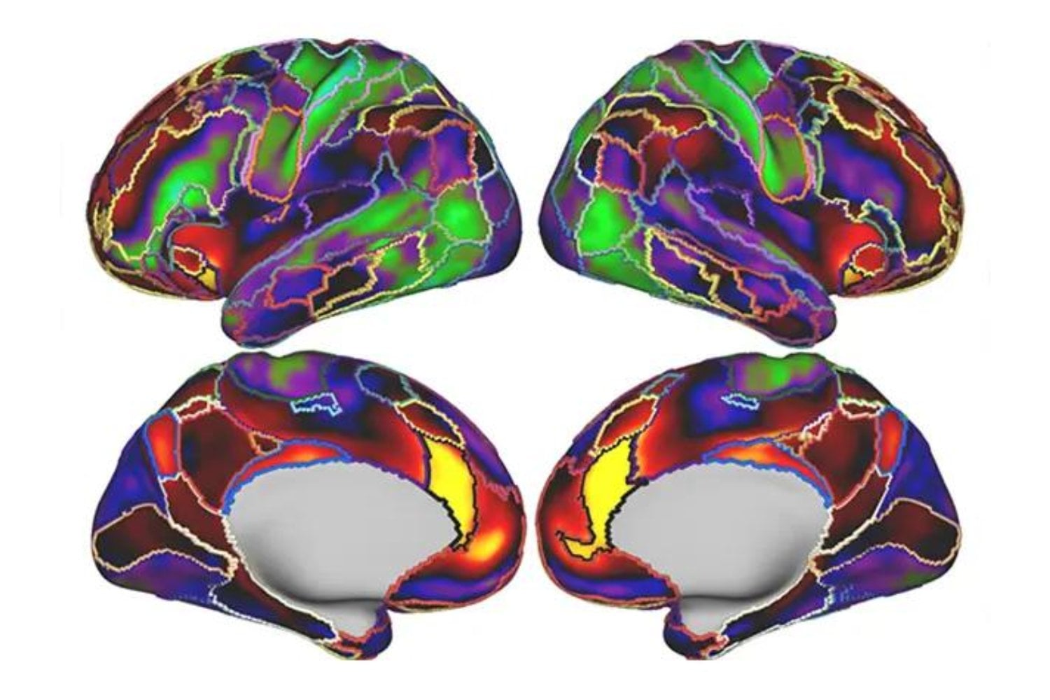 La depresión podría dejar una huella en el cerebro antes de que aparezca el primer síntoma. Los científicos encontraron algo que no esperaban