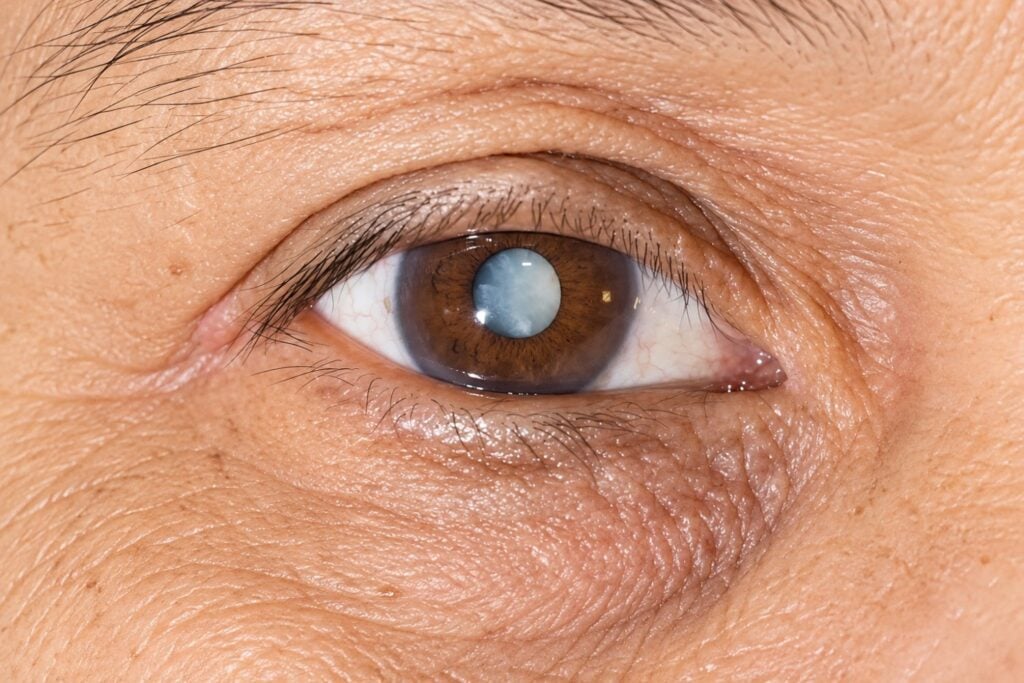 Volver a leer sin gafas después de años puede ser una señal de cataratas