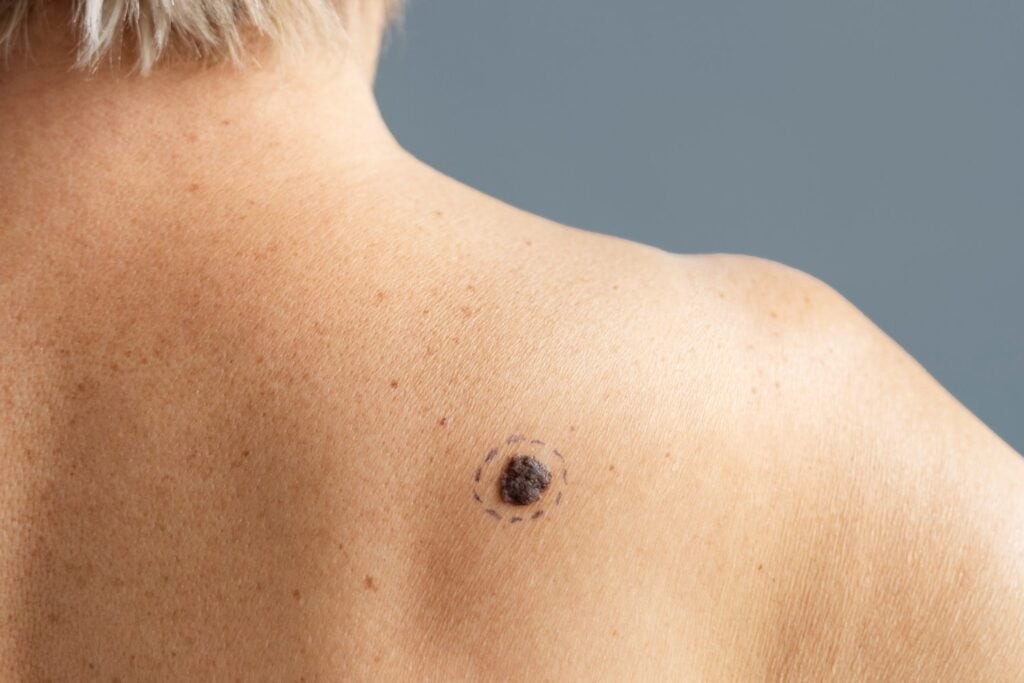 El cambio en un lunar que puede ser una señal de melanoma y no conviene ignorar