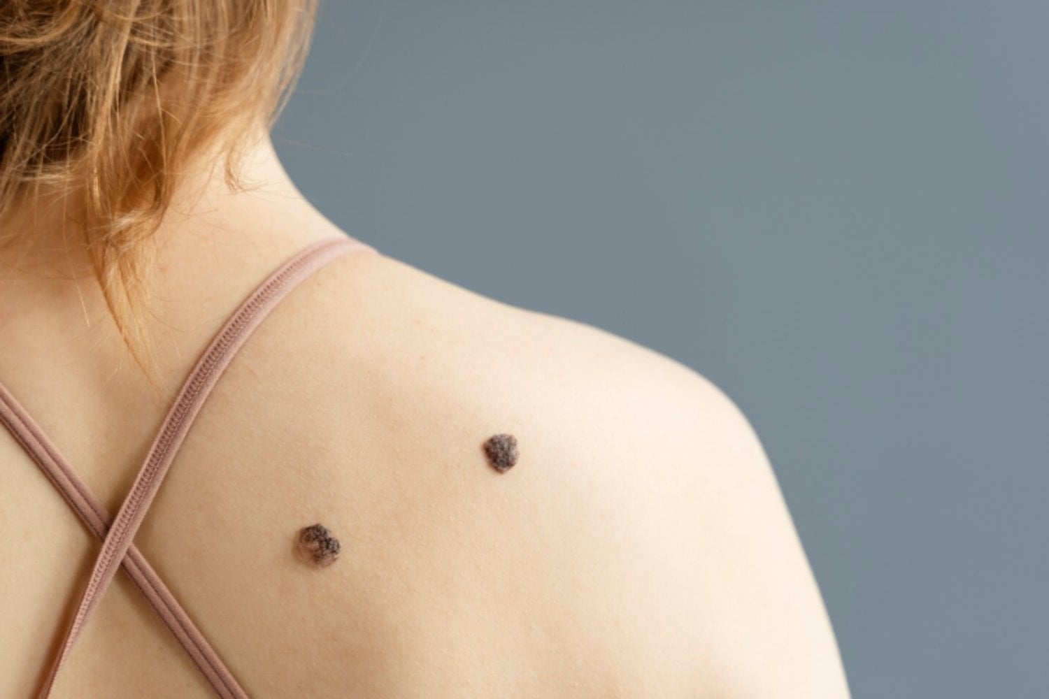 El cambio en un lunar que puede ser una señal de melanoma y no conviene ignorar